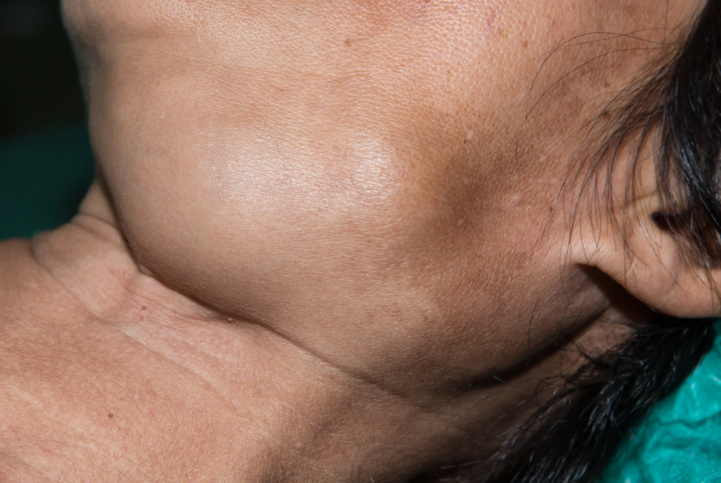 Salivary Gland Tumors doctorlansford.com